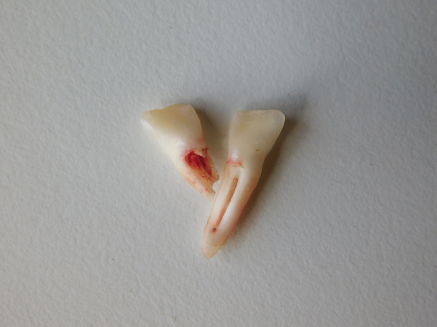 抜けた乳歯に根っこが無くても大丈夫！ それが「ふつう」に抜けた証拠です｜418プロジェクト【虫歯ゼロ活動】